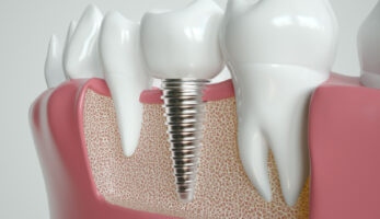 Implantologia dentale di eccellenza a Milano e Bergamo.