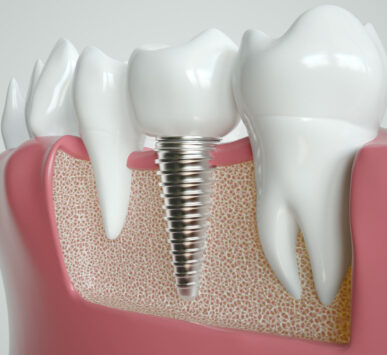 Implantologia dentale di eccellenza a Milano e Bergamo.