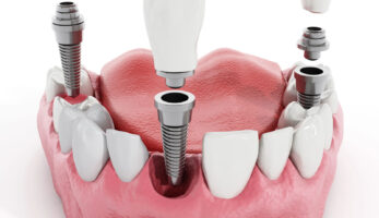 protesi dentale milano bergamo