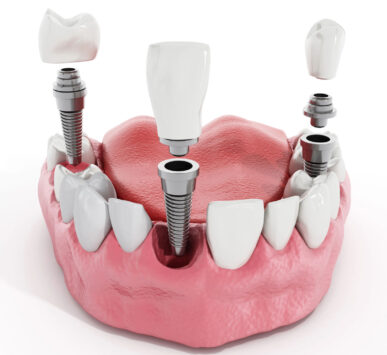 protesi dentale milano bergamo