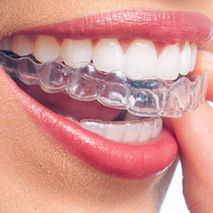 ortodonzia invisibile