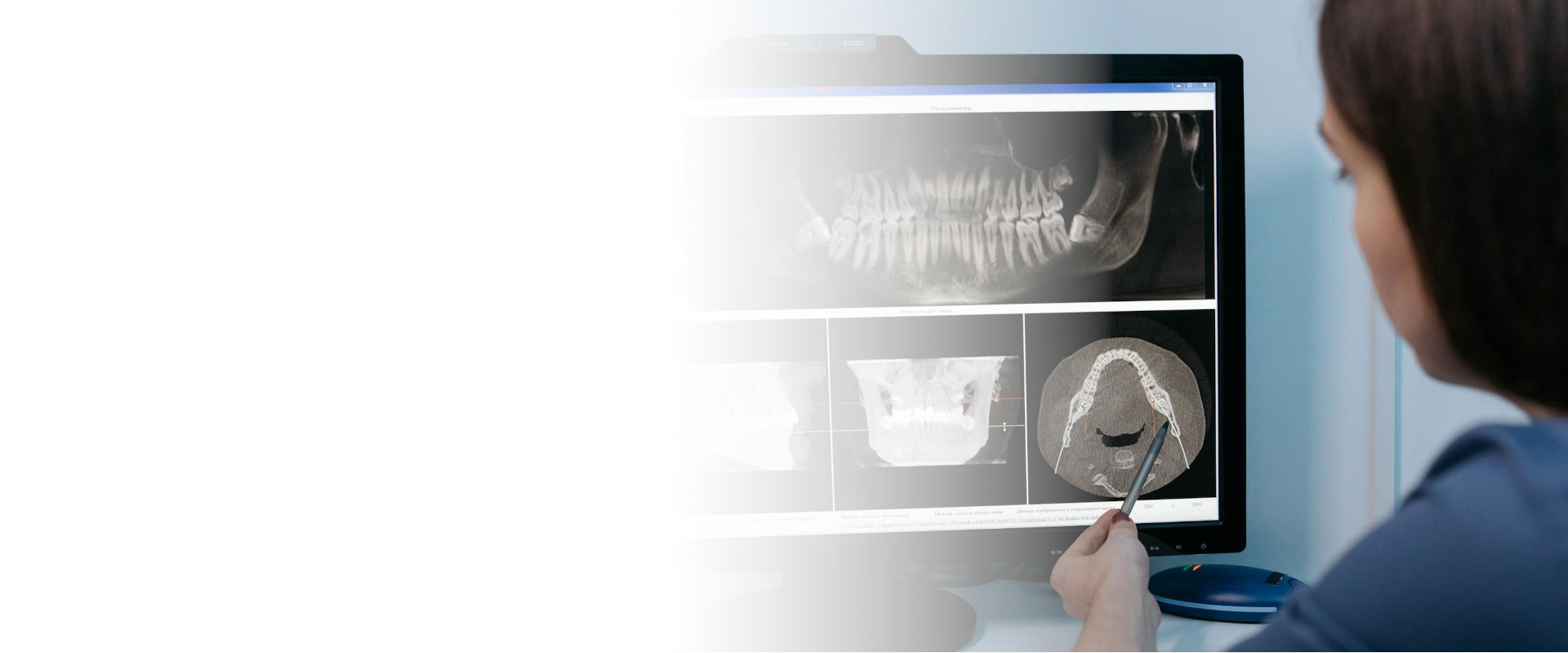 rigenerazione ossea dentale slide 4